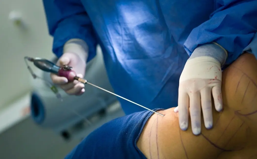 Jakie procedury i metody stosuje szpital przy wykonywaniu zabiegu liposukcji?
